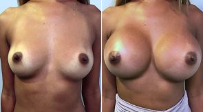 breast-augmentation-01a-schlesinger