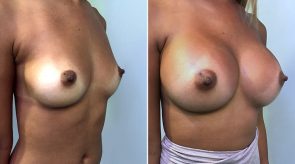 breast-augmentation-01b-schlesinger