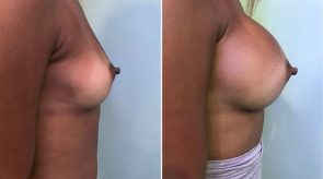 breast-augmentation-01c-schlesinger