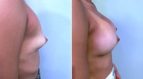 breast-augmentation-02c-schlesinger
