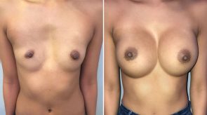 breast-augmentation-03a-schlesinger