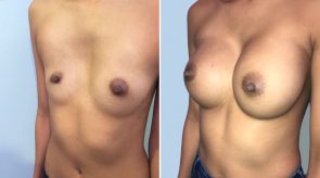 breast-augmentation-03b-schlesinger