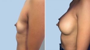 breast-augmentation-03c-schlesinger