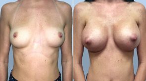 breast-augmentation-04a-schlesinger
