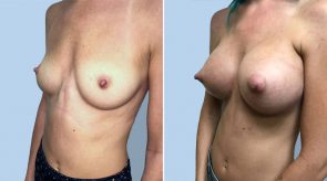 breast-augmentation-04b-schlesinger