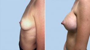 breast-augmentation-04c-schlesinger