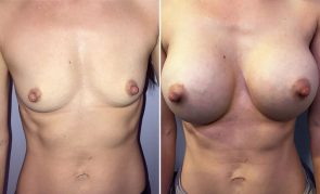 breast-augmentation-H23476M-a-schlesinger