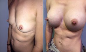 breast-augmentation-H23476M-b-schlesinger