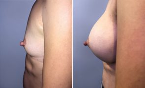breast-augmentation-H23476M-c-schlesinger
