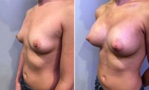 breast-augmentation-M00001S-b-schlesinger