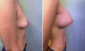 breast-augmentation-M00001S-c-schlesinger
