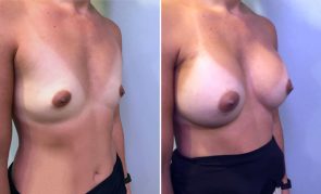 breast-augmentation-M23667K-b-schlesinger