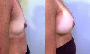 breast-augmentation-M23667K-c-schlesinger