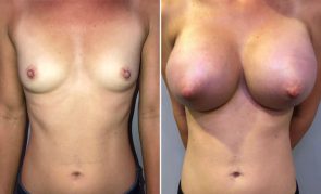 breast-augmentation-S23457R-a-schlesinger