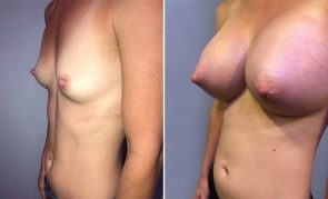 breast-augmentation-S23457R-b-schlesinger