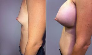 breast-augmentation-S23457R-c-schlesinger