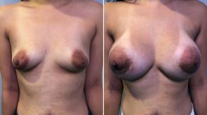 breast-augmentation-05a-schlesinger