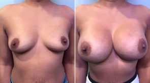breast-augmentation-22868a-schlesinger