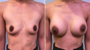 breast-augmentation-22976a-schlesinger