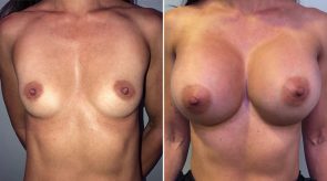 breast-augmentation-23971a-schlesinger