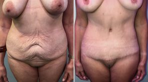 abdominoplasty-posterior-body-lift-16272a-schlesinger