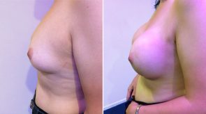 breast-augmentation-16277c-schlesinger