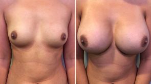 breast-augmentation-16302a-schlesinger