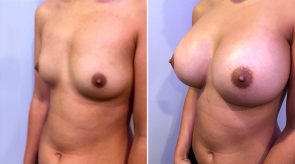 breast-augmentation-16302b-right-schlesinger