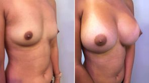 breast-augmentation-16302d-left-schlesinger