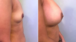breast-augmentation-16302d-schlesinger