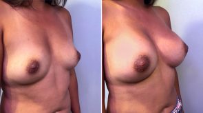 breast-augmentation-24274b-schlesinger