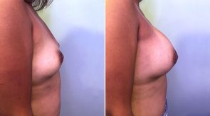 breast-augmentation-24274c-schlesinger