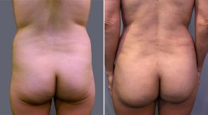 breast-augmentation-liposuction-16277d-schlesinger