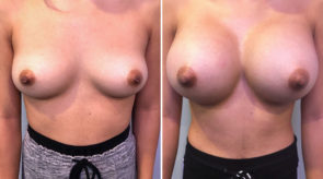 breast-augmentation-24528-17476a-schlesinger