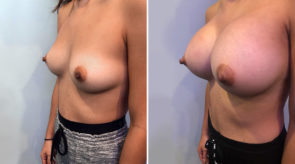breast-augmentation-24528-17476b-schlesinger