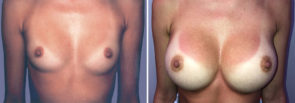 breast-augmentation-15425-17739a-schlesinger