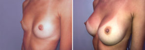 breast-augmentation-15425-17739b-schlesinger