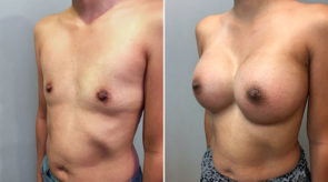 breast-augmentation-22277-17740b-schlesinger