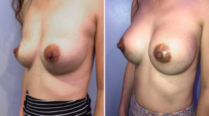 breast-augmentation-24639-17863b-schlesinger
