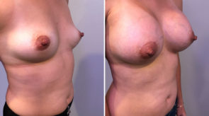 breast-augmentation-asymmetry-24306-17874b-schlesinger