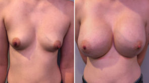 breast-augmentation-24059-17983a-schlesinger