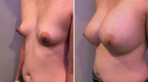 breast-augmentation-24059-17983b-schlesinger