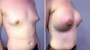 breast-augmentation-24500-17868b-schlesinger