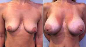 breast-augmentation-asymmetry-24572-17978a-schlesinger-