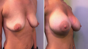 breast-augmentation-asymmetry-24572-17978b-schlesinger-