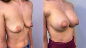 breast-augmentation-20725b-schlesinger