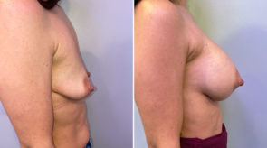 breast-augmentation-20725c-schlesinger