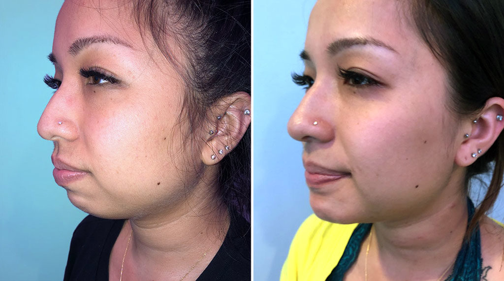 Before and after image of Injectables patient results
