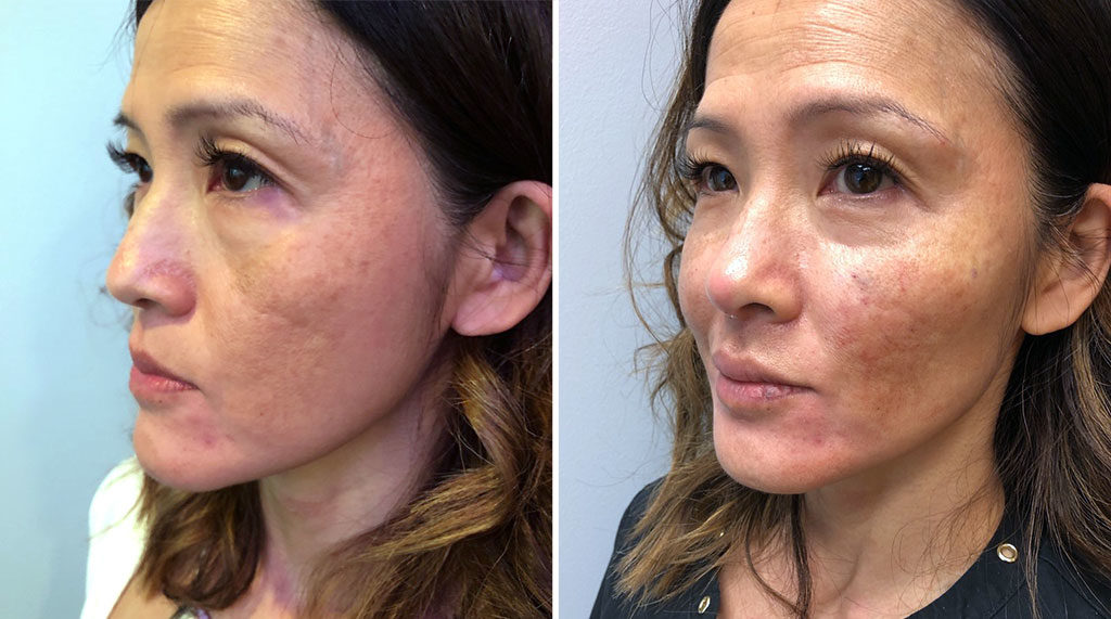 Before and after image of Injectables patient results
